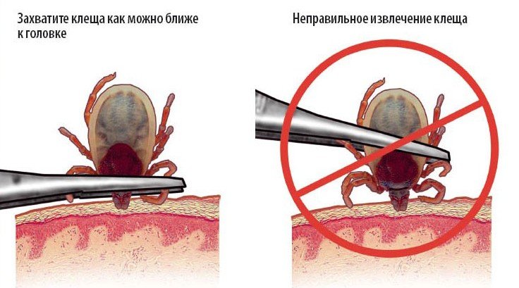 Кліщ на тілі: як витягти комахи?